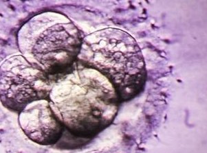 女性多囊肾能做三代试管吗？看完这些就能明白了