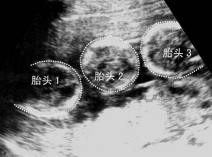 2026年艾滋病患者可以去曲靖市妇幼做三代试管吗？大概需要花费多少钱？